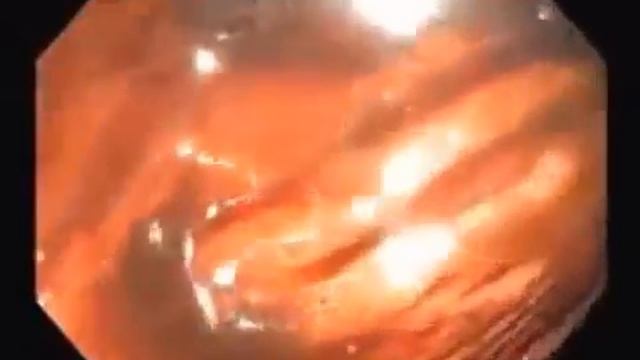 ЗОЖ | Чистый кишечник - залог здоровья смотреть онлайн