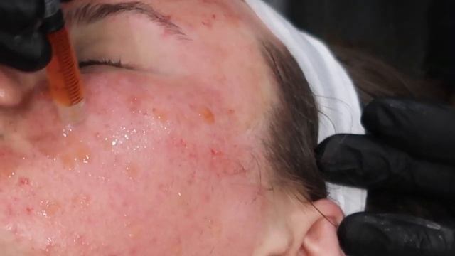 Microneedling with PRF | Platelet Rich Fibrin | Blood Facial смотреть онлайн
