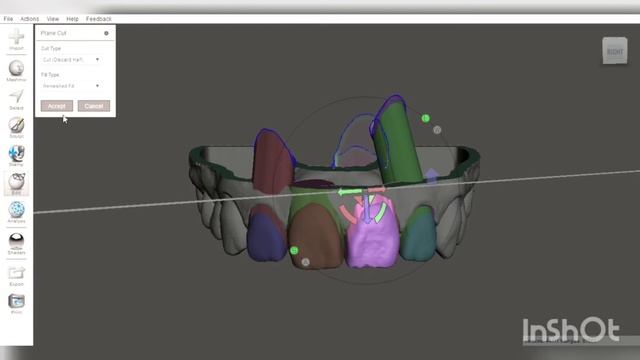 DISEÑO de ALINEADORES ORTODÓNTICOS con software MESHMIXER смотреть онлайн