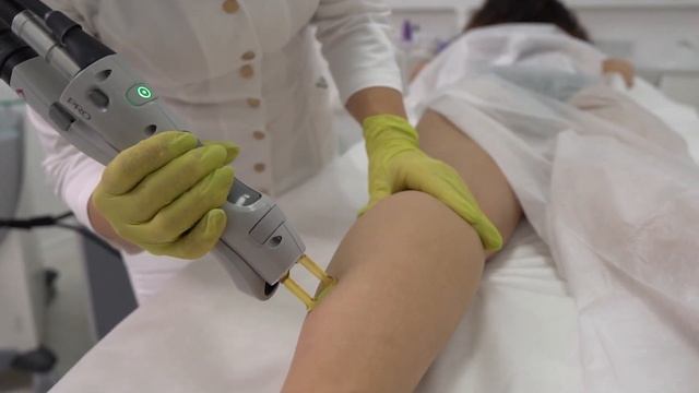 Лазерная эпиляция на аппарате Candela смотреть онлайн