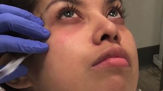 Belotero Injections to Correct the Tear Trough Hollow смотреть онлайн