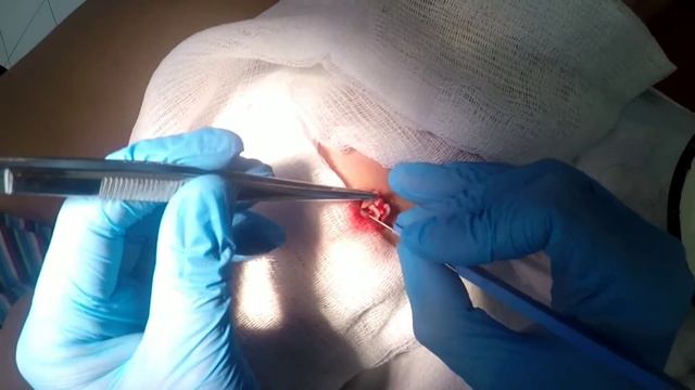 #медицина онлайн #хирургия #операция #Атерома как правильно удалять?? смотреть онлайн