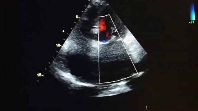 severe mitral stenosis with dilated LA смотреть онлайн