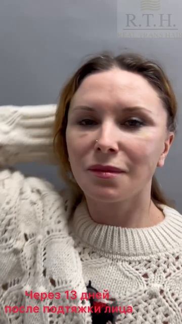 Подтяжка лица и шеи с перемещением СМАС смотреть онлайн