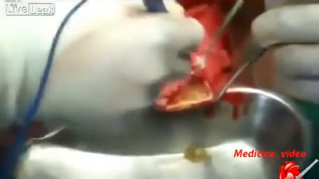 Liver echinococcosis смотреть онлайн