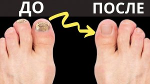 ДИМЕКСИД избавит от самого запущенного грибка