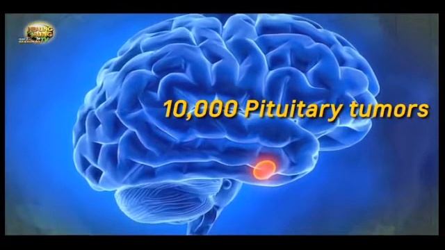 Healing Galing SO10EP10   Pituitary Tumor Pt1