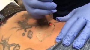 Neatcell Picosecond Pen Tattoo Removal