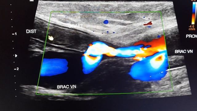 DOPPLER TEACHING OF AV FISTULA GRAFT OCCLUSION-REFER SERIES BY DR S.PRADEEP смотреть онлайн
