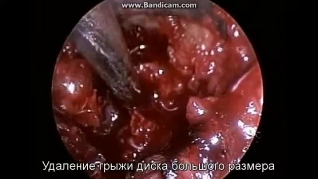УДАЛЕНИЕ ГРЫЖИ МЕЖПОЗВОНКОВЫХ ДИСКОВ БОЛЬШИХ РАЗМЕРОВ смотреть онлайн