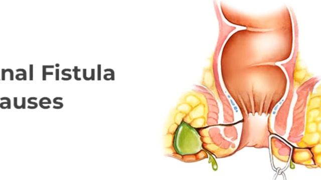 Anal Fistula Best Treatment | Symptoms | Reasons In Urdu | Hindi | Baghandar | Nasoor Ka Desi Ilaj