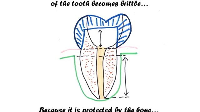 Are Posts in Root Canal Teeth Necessary? смотреть онлайн