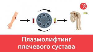 Плазмолифтинг плечевого сустава в клинике Стопартроз