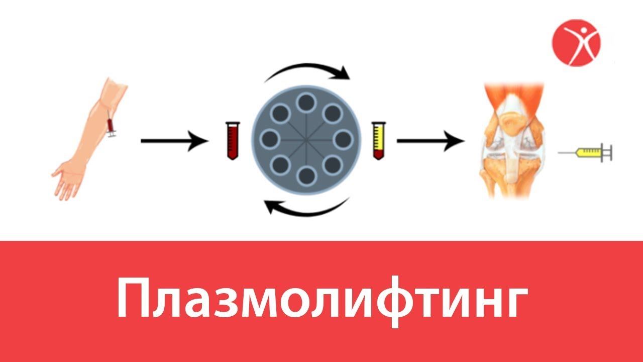 Плазмолифтинг в ортопедии смотреть онлайн