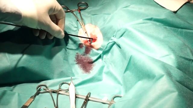 Tratamiento quirúrgico de la Filariasis смотреть онлайн