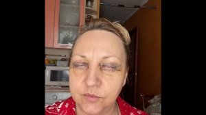 Блефаропластик, как проходит реабилитация.