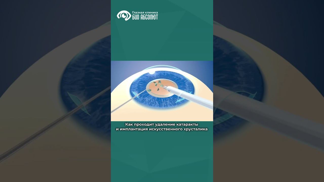 #здоровьеглаз #катаракта #глаукома #лечениекатаракты #иол #ковров #иваново #офтальмолог #глаза смотреть онлайн