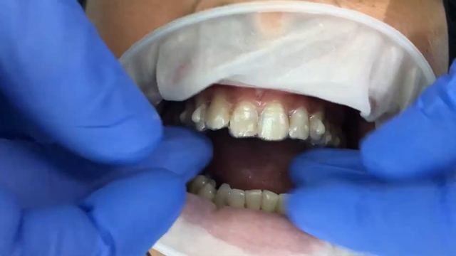 Selina's Invisalign Journey Video 5 смотреть онлайн