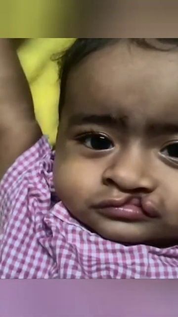 Cleft Cutie's Amazing Transformation After Cleft Lip Surgery In India | Dr Mathew PC #shorts смотреть онлайн