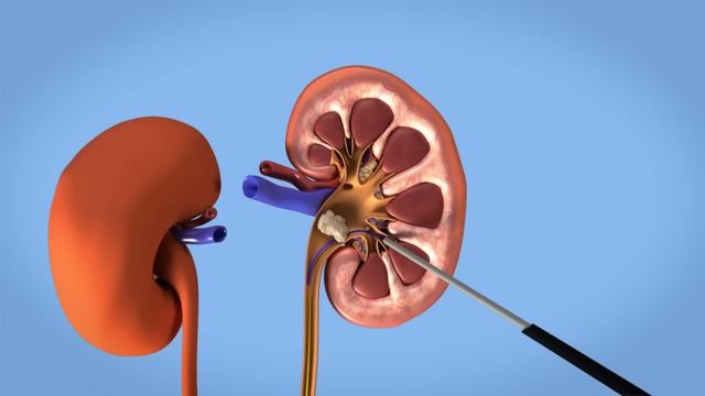 Removal of kidney stones: PCNL смотреть онлайн