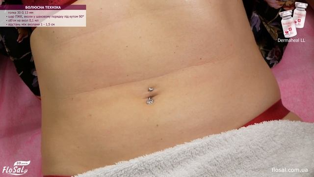 Зменшення об'єму жирових відкладень в області живота🎯 ліполітичний мезококтейль Dermaheal LL