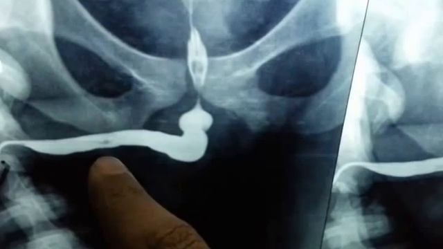 Retrograde Urethrogram [RGU/MCU] Interpretation Basics