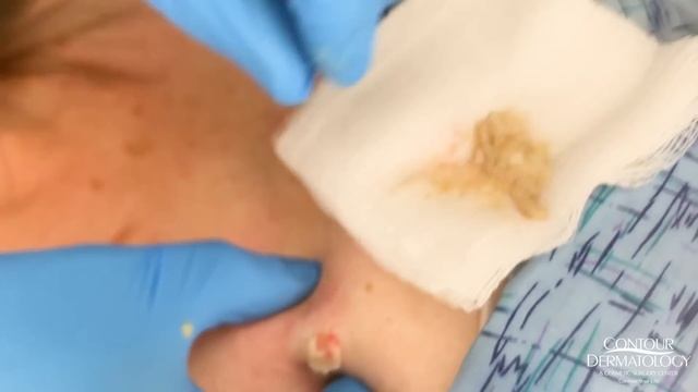 Cyst (Salsa Verde) Pop And Squeeze Extraction