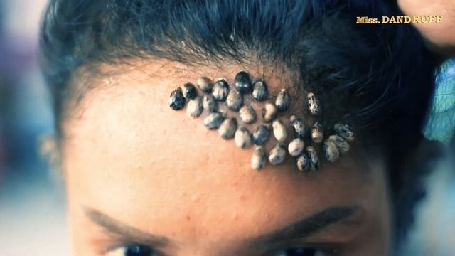 Secret of Million Giant Ticks is Living on Poor Girl's Ear #972 смотреть онлайн