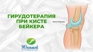 Гирудотерапия при кисте Бейкера