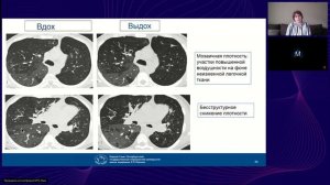 Синдром - понижение плотности легочной ткани и полости