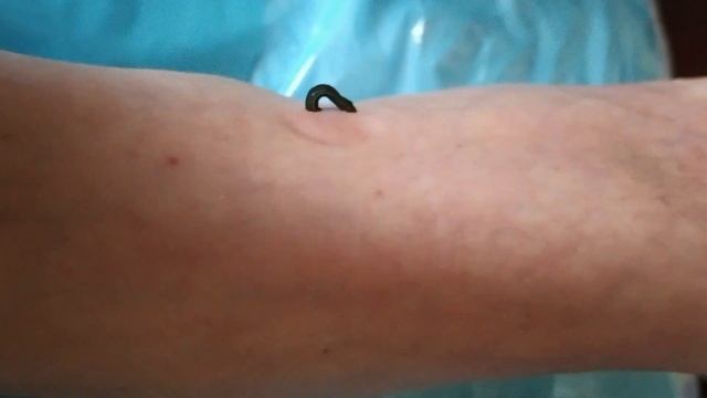 Гирудотерапия по-домашнему Попытка пинцетом