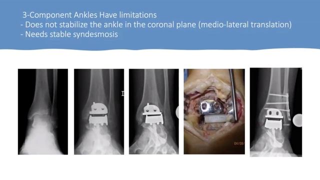 FFAFS: "Importance of Syndesmotic Stability in TAR", 4/27/23 смотреть онлайн