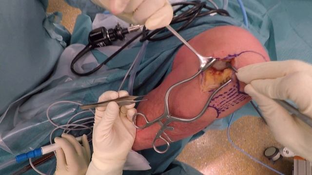 LESIONI OSTEOCONDRALI DEL GINOCCHIO: cosa fare? [subtitles available] смотреть онлайн