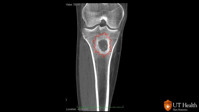 Imaging of Osteomyelitis смотреть онлайн