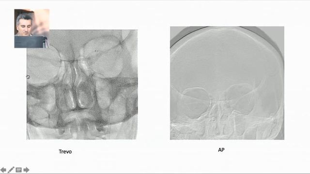 Dr Atilla Ozcan,Thrombectomy Procedure Step смотреть онлайн