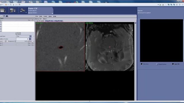 CSF Post Processing with Flow Analisys | GE Healthcare смотреть онлайн