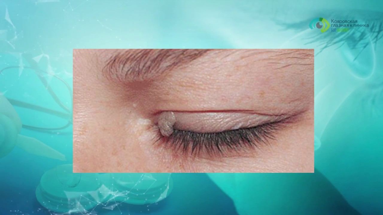 Папиллома века - удалить просто! смотреть онлайн