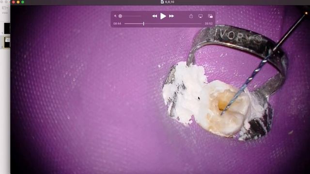 Root Canal Glide Path Help - 6,8,10 sequence - The Calcified Tooth Series смотреть онлайн