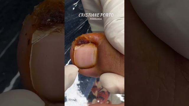 🤤|(PARTE 1)UNHA ENCRAVADA ENORME ! #satisfatório #unhas #nails #viralvideo смотреть онлайн