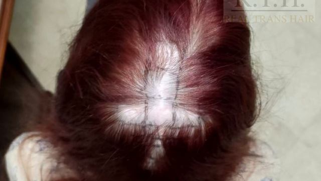 До и через год после пересадки волос в послеоперационный рубец! смотреть онлайн