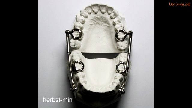 Herbst Appliance. Аппарат Гербста. Ортодонтия.
