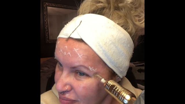 New Meso botox treatment with Hyaluron pen can make you look years younger! смотреть онлайн