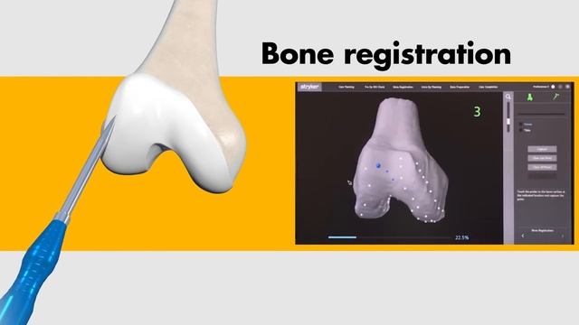 Stryker Total Knee Arthroplasty
