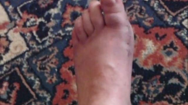 The Bunion Chronicles: Walking Again ! смотреть онлайн