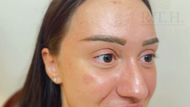 Пересадка бровей смотреть онлайн