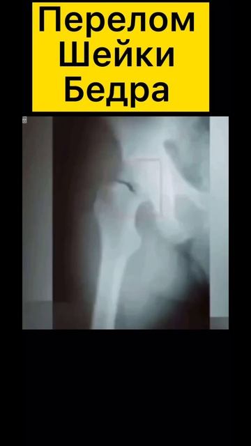 Перелом шейки бедра - а она хотела все лишь танцевать🧑⚕️ #медицина #хирург смотреть онлайн