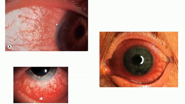 Uveal Tract 1 смотреть онлайн