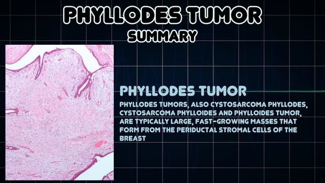 Phyllodes tumor (Medical Symptom) смотреть онлайн
