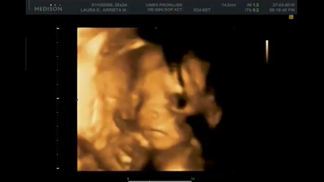 Ecografia en 3D - Bebe Sandoval Arrieta смотреть онлайн