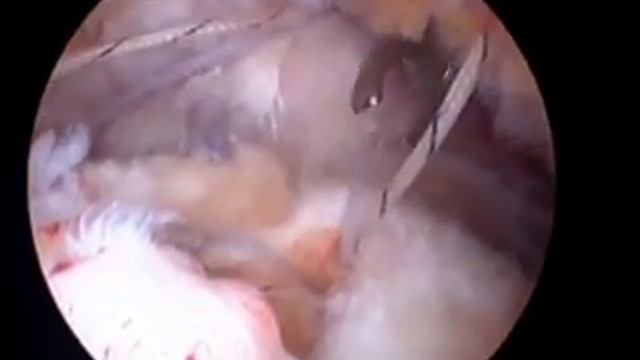 Rotator Cuff Tear and Surgery for Repair ppt.wmv смотреть онлайн